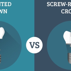 Screw Retained vs Cement Retained Implants